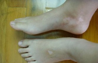 暖气片上烘袜竟致中毒？